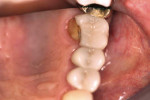 Figure 1  Tooth No. 14 lingual broken crown.