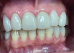 Fig 8 and Fig 9. Case No. 1. Six-week images show healthy gingiva.