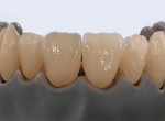 The latest blanks of the Zolid DNA generation are true all-rounders! Amann Girrbach’s new Zolid Gen-X zirconia combines excellent esthetic properties and outstanding mechanical values to exceed any indication limitations.
