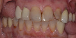 Fig 1. Intraoral view of patient in maximum intercuspation. Note severe resorption of the edentulous sites, caries, and mismatched shades of crowns and natural teeth.