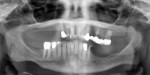 Fig 4. Preoperative panoramic radiograph. Note failing restorations and No. 14 abutment tooth before the retainer detached and severe resorption of the mandibular left posterior region.