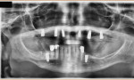 Fig 5. Postoperative panoramic radiograph showing implant placement and sinus lifts.