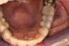 Figure 7  This patient had severe crowded with completely blocked-out canines. Premolar extraction appears to be inevitable.