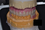 Fig 6. Wax try-in. The artificial tooth arrangement is tried in the patient’s mouth to ascertain esthetics and occlusion.