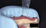 Fig 7. Silicone index for space analysis to help determine the restorative space. A measurement is made from the platform of the abutment to the occlusal plane using the silicone index that was made from the wax try-in.