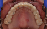 Fig 12. Intraoral view of maxillary prosthesis. Note the screw-access holes of the implants in relation to the position of the teeth.