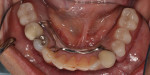 Fig 13. Intraoral view of the mandibular prosthesis showing the implant-assisted RPD without the need for clasps.