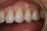 Two shades of a flowable restorative composite (Evanesce Flow™ [B1E and A1U], Clinician’s Choice) were placed on the teeth and light cured in order to test the results of different levels of opacity. An 80% opaque shade (B1E) was tested on the bicuspid to see if it would yield more translucent results and create an appearance similar to that of natural enamel, and an 85% opaque shade (A1U) was placed on the cuspid to test a less translucent result. After evaluation, the 85% opaque shade was selected because it provided the best color match and level of opacity.