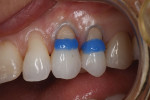 The teeth were prepared at the CEJ with an irregular bevel to enhance the overall bond to the tooth structure and to create a seamless restoration. If an intraoral sandblaster is available, sandblasting the teeth prior to etching will remove contaminants and help to increase bond strength by improving the microporosity of the surfaces. A selective-etch technique was chosen for the adhesive procedure to diminish the potential for staining and premature marginal breakdown.2 A 35% phosphoric acid etchant (Ultra-Etch™, Ultradent) was applied, followed by a self-etching primer (Peak™ SE Primer, Ultradent). Alternatively, a total-etch adhesive can be used, but if so, it is recommended to also use a glutaraldehyde-based desensitizer.