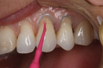 After etching and priming, a light-cure universal adhesive (Peak™ Universal Bond, Ultradent) was applied with a microbrush.