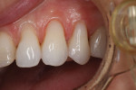 Immediate posttreatment retracted close-up photograph of the final Class V restorations, which exhibit seamless transitions between the restorative material and the natural tooth structure and will protect the tooth structure from future damage.
