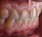 Fig 3. Preoperative right lateral closeup view with teeth in MIP.