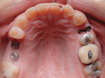 Fig 4. Preoperative maxillary occlusal view. Implants had been placed in the upper right quadrant because the patient was originally unsure about proceeding with comprehensive treatment.