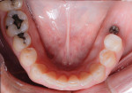 Fig 5. Preoperative mandibular occlusal view. An implant had been placed in the lower left quadrant because the patient was originally unsure about proceeding with comprehensive treatment.