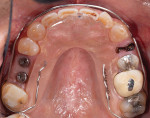 Fig 7. Maxillary occlusal view with Kois deprogrammer in place and adjusted.