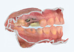 Fig 8. As part of the digital smile design
plan, mounted models show a scan of the
patient in CR position coincident to the MIP
position in Fig 6.
