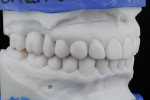 Fig 11. Right lateral view of printed and mounted models of digital smile design and wax-up.