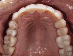 Fig 17. Postoperative maxillary occlusal view.