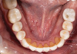 Fig 18. Postoperative mandibular occlusal view.