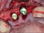 Fig 2. Implant placement with hand-tightened cover screws (0 mm).