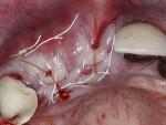 Fig 4. Primary closure with 3-0 PTFE continuous interlocking sutures and 4-0 single interrupted chromic gut sutures.