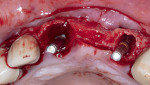 Fig 8. Full-thickness flap occlusal view.