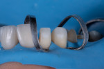 Fig 3. Baseline photograph with white_balance reference card, a tool used that allows the lab technician to calibrate the shade photo to optimize shade match to adjacent teeth in the final restoration.