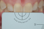 Fig 4. Rubber dam on right central incisor, in place for 1 minute.