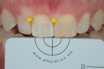 Fig 9. Photograph showing right central incisor 1 hour after rubber dam removal.