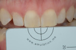 Fig 12. Photograph showing right central incisor 12 hours after rubber dam removal.