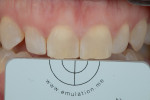 Fig 13. Photograph showing right central incisor 24 hours after rubber dam removal.