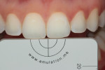 Fig 14. With subject retracted, photograph showing right central incisor at baseline.