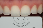 Fig 15. With subject retracted using metal retractors, photograph showing central incisors, baseline.