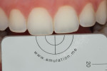 Fig 16. With subject retracted using metal retractors, photograph showing central incisors at 3 minutes.