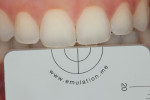 Fig 18. With subject retracted using metal retractors, photograph showing central incisors post wrapping teeth in wet gauze for 10 minutes.