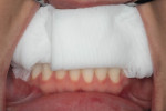 Fig 19. Subject seen in Fig 15 through Fig 18 with teeth wrapped in wet gauze, which acts to rehydrate teeth to bring dehydration into clinically imperceptible shade difference range.