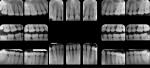 Fig 1. Full-mouth radiographic series, Case 1.