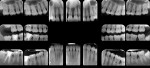 Fig 2. Full-mouth radiographic series, Case 2.