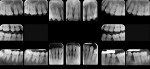 Fig 3. Full-mouth radiographic series, Case 3.