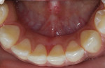 Fig 5. Postsurgical presentation of ankyloglossia site noted in Fig 4, Case 3.