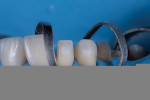 Fig 11. Teeth Nos. 6 and 7 isolated with accessory clamps in preparation for veneer insert.