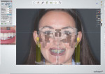 Fig 3. Intraoral scan and full-face photo are overlaid in CAD software to determine proper midline position and length of designed restorations.