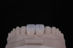 Fig 9. Stained and glazed crowns are placed on the model to check for fit.