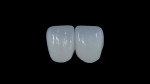 Fig 10. Final restorations on black background show translucency and color gradients.