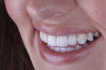 Fig 14. Postoperative left view of smile showing the contours and texture of the final restorations.