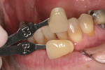 Figure 2  The incisal two thirds of this tooth closely match shade C3 while the cervical third matches B4.