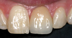 Figure 3  The left incisor exhibits translucency. The gray color of the incisal third is caused by the black background being seen through the tooth.
