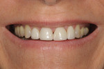 Fig 2. Preoperative smile; note uneven color of teeth and wide maxillary anterior crowns.