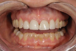 Fig 3. Preoperative retracted view; note wide, flared crowns Nos. 7 through 10 and uneven gingival margins.