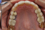 Fig 5. Preoperative maxillary arch showing chipping/wear of porcelain crowns.